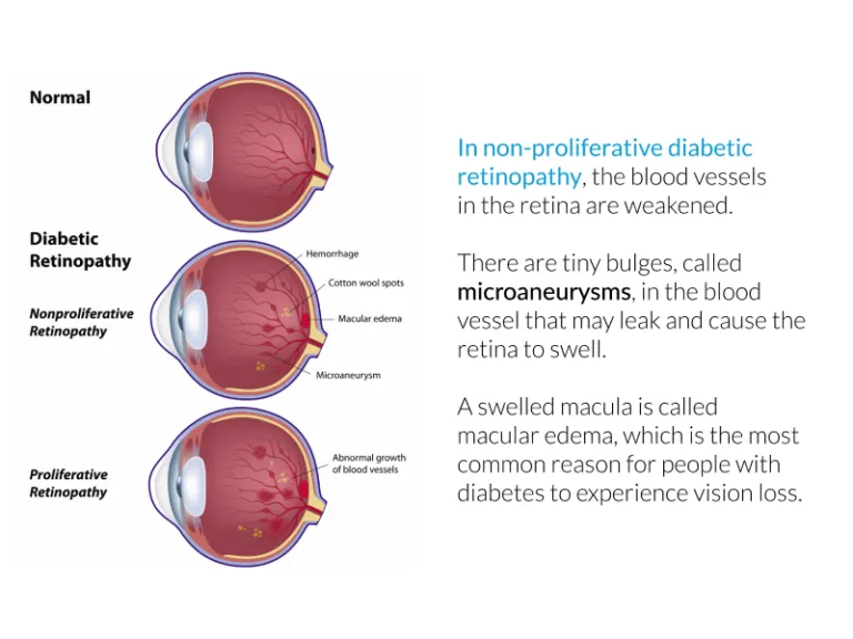 non proliferative and proliferative diabetic Retinopathy 768x576 11zon