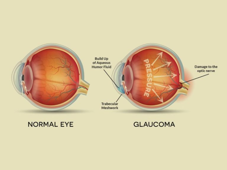 Diseases Leading to Optic Atrophy