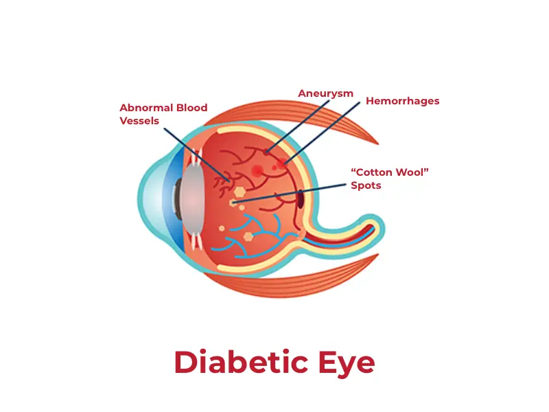 First Sign of Diabetic Retinopathy