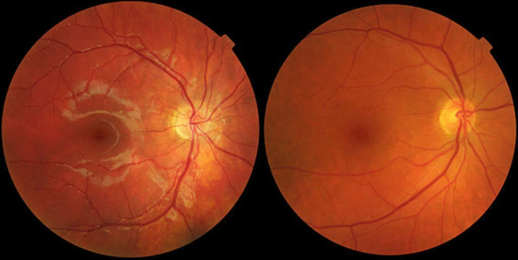 age related macular degeneration the most comprehensive guide about amd 1