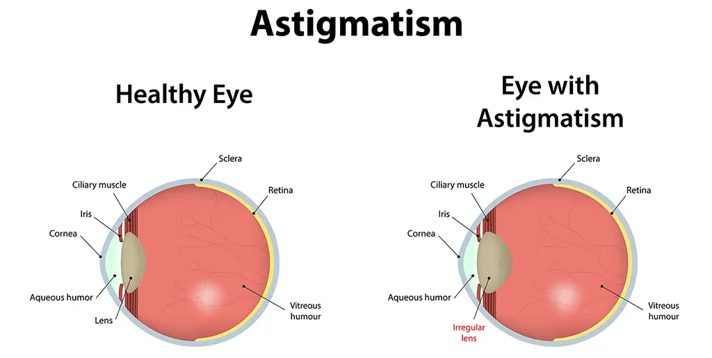 astigmatism common eye condition banner