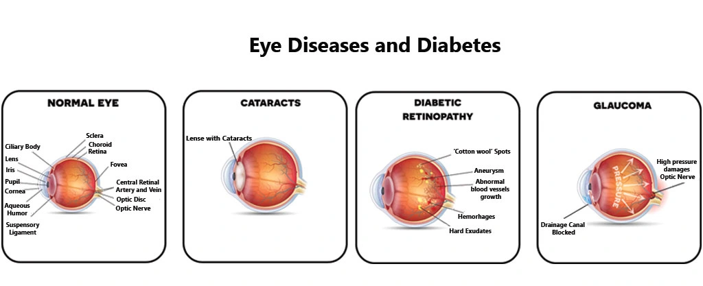 can i have glaucoma from diabetes image