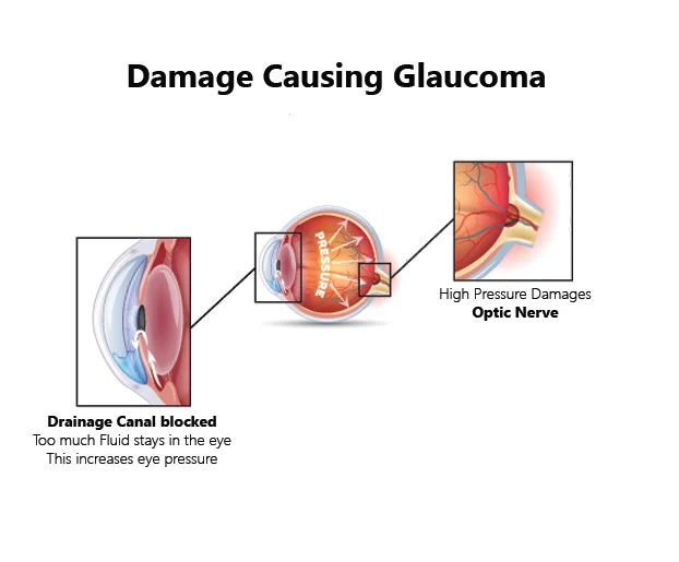 damage causing glaucoma faqs glaucoma image