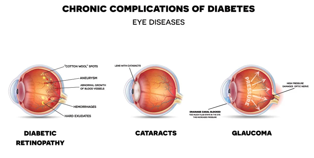 diabetic eye problems symptoms treatment and prevention banner