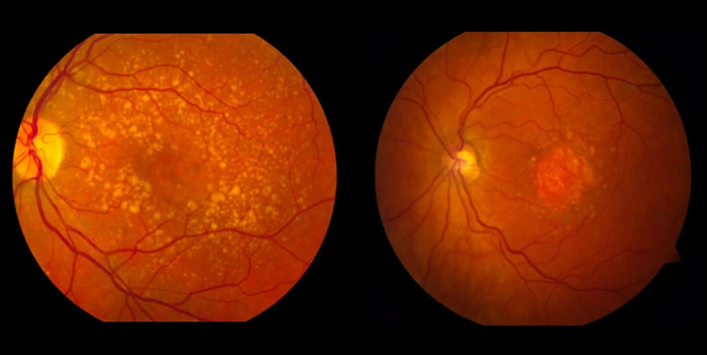 difference between dry vs wet age related macular degeneration banner