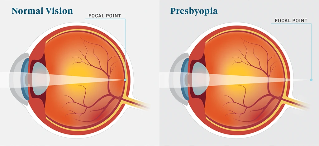 presbyopia common eye condition related to aging banner