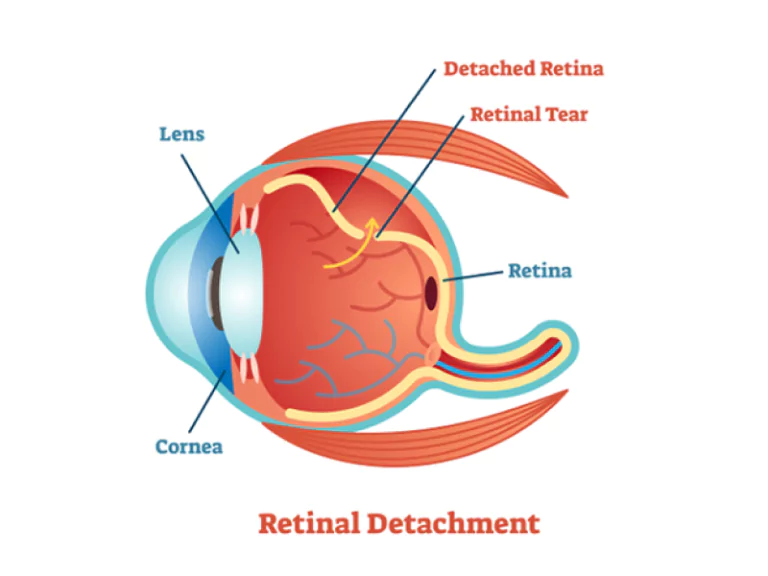 retinal detachment image 66daa4ea999ee