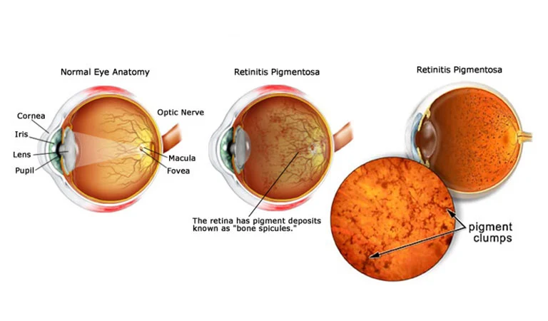 retinitis pigmentosa causes and symptoms 1