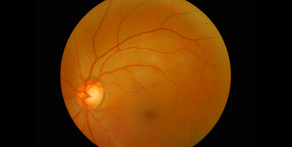 retinitis pigmentosa the disease and some viable treatment options