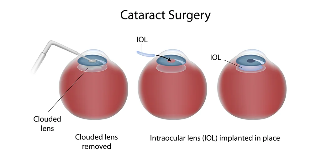 types of cataract surgery cataract surgery complications