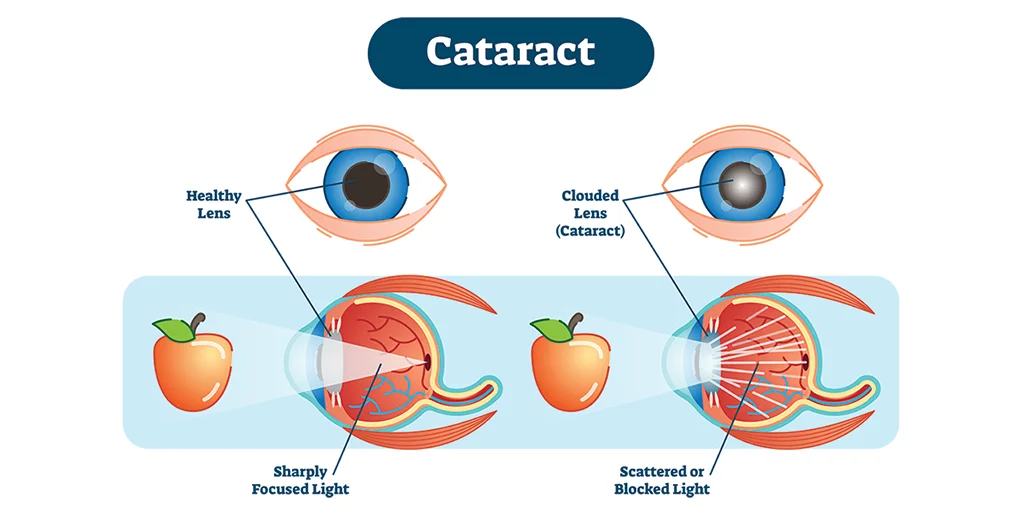 types of cataract surgery