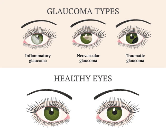 types of glaucoma image