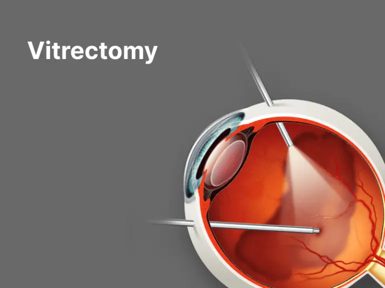 victrictomy