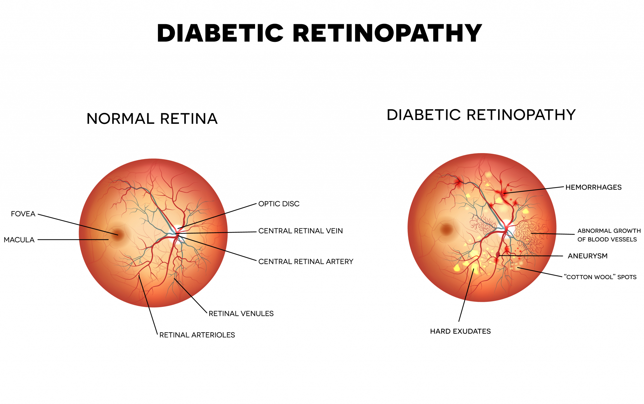 what causes diabetic retinopathy