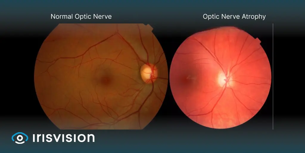 what diseases cause optic atrophy banner