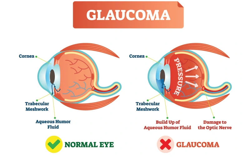 what is glaucoma faqs glaucoma