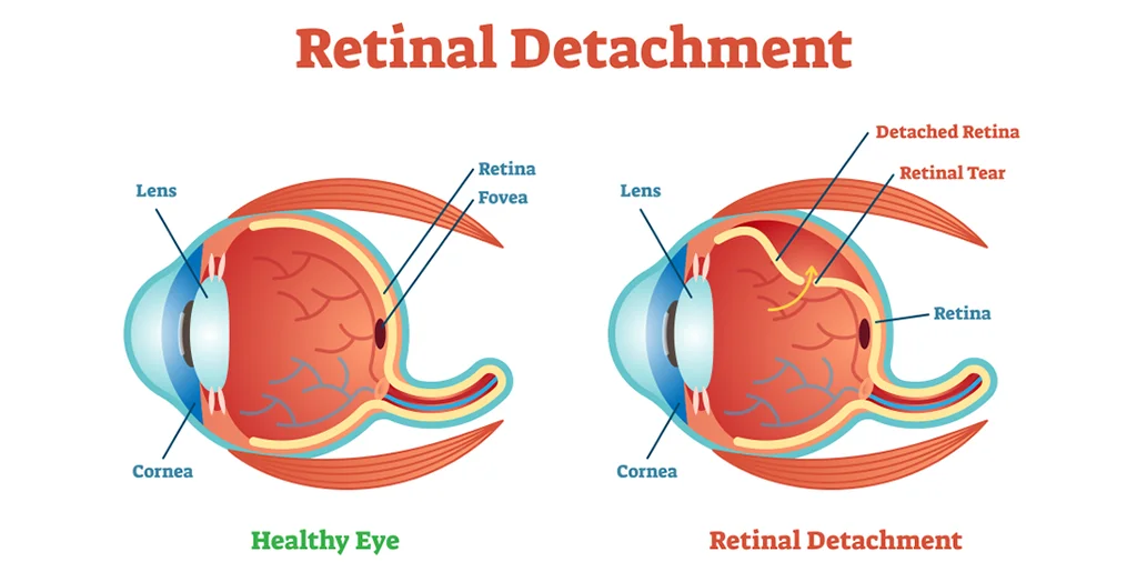 what is retinal detachment various types causes and treatments