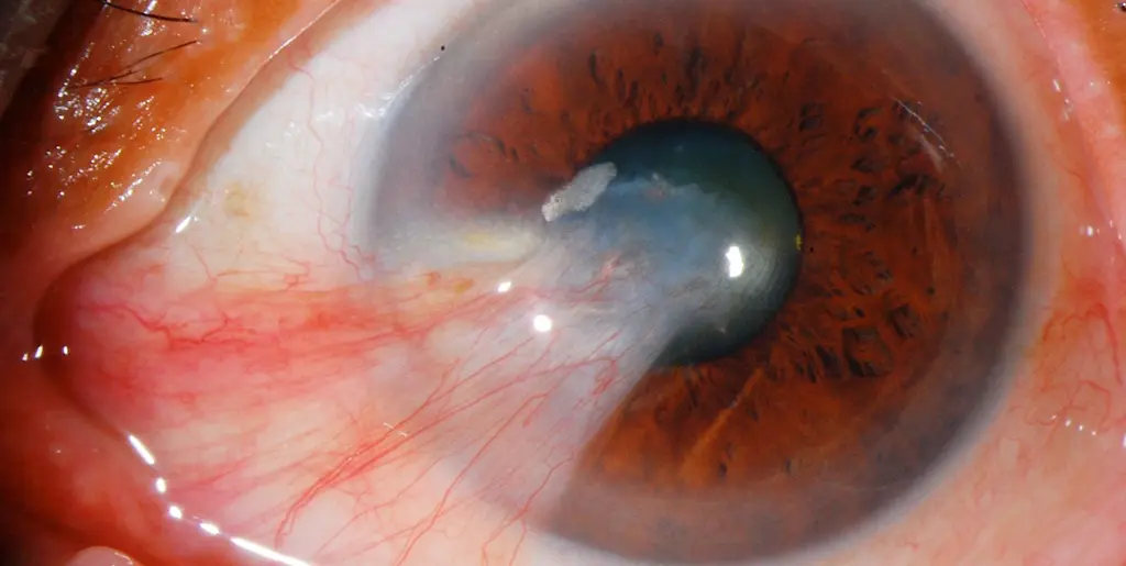 what is uveitis causes symptoms and treatment options